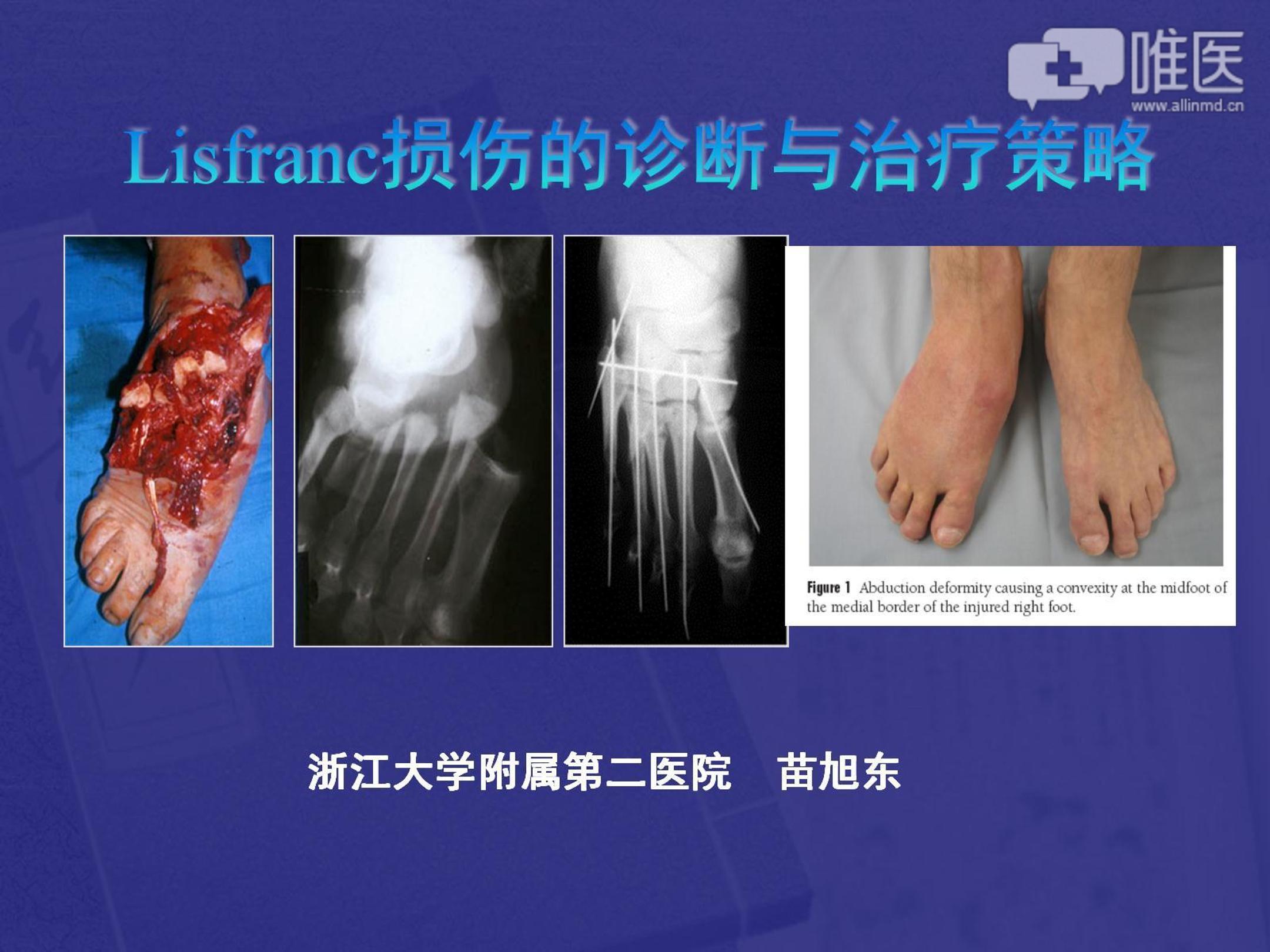 lisfranc损伤的诊断与治疗策略