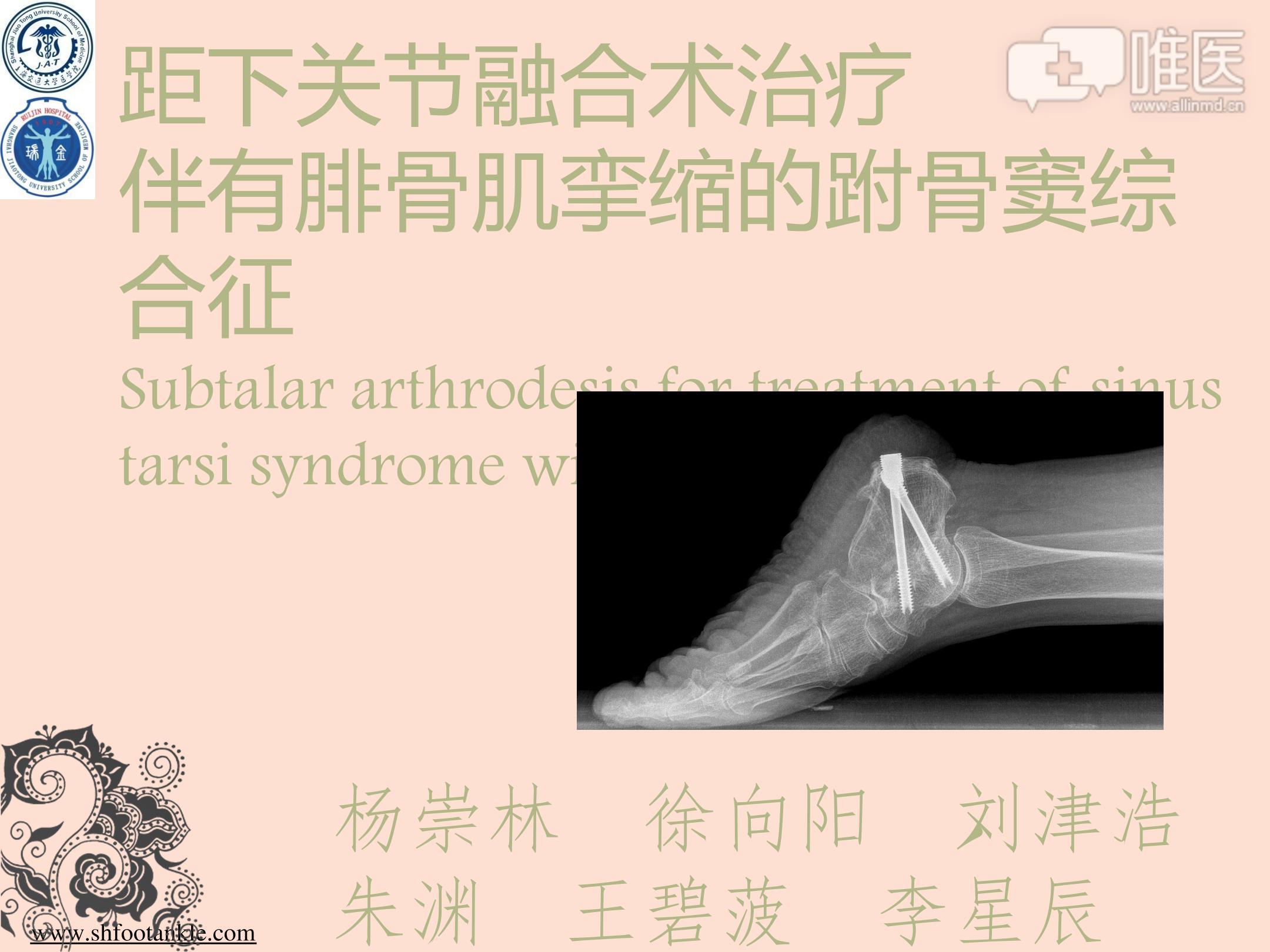 距下关节融合术治疗 伴有腓骨肌挛缩的跗骨窦综合征